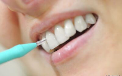 Escova interdental pode ajudar a prevenir as cáries