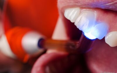 Clareamento dental interno: Descubra como funciona e os benefícios para a saúde do seu sorriso