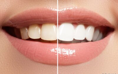 3 hábitos que podem estar deixando seus dentes amarelados