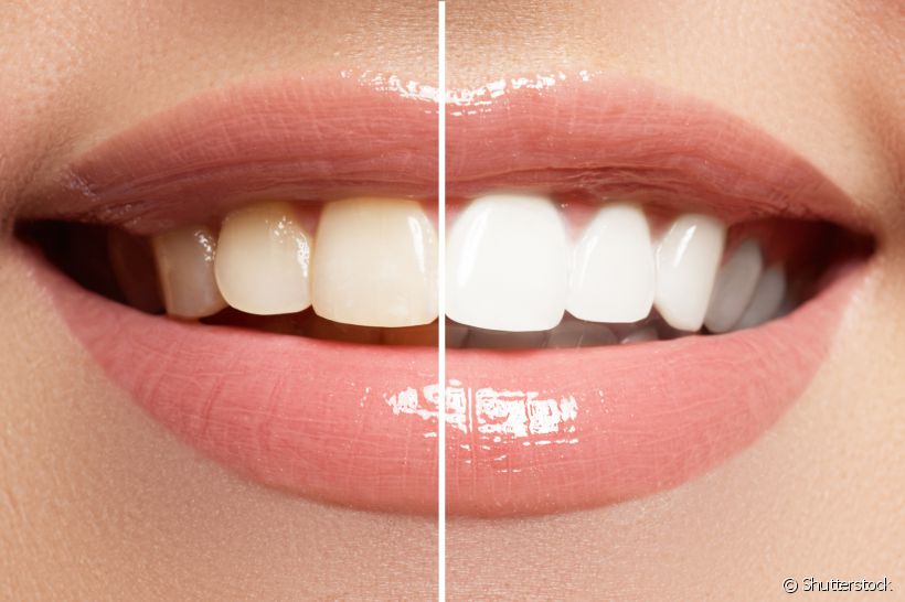 3 hábitos que podem estar deixando seus dentes amarelados