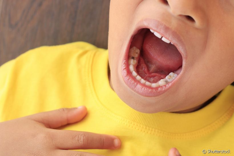 Você sabe qual é o tipo de cárie dentária mais grave?