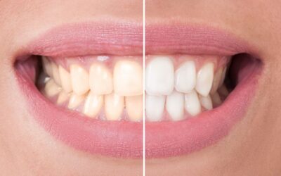 7 mitos sobre clareamento dental: saiba o que não é verdade!