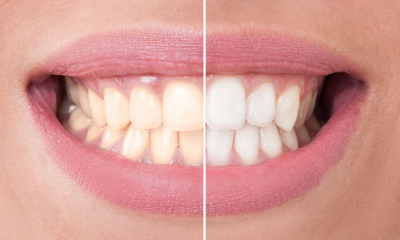 7 mitos sobre clareamento dental: saiba o que não é verdade!