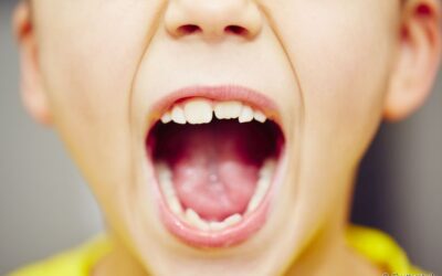 Mordida aberta: descubra o que a condição causa na saúde bucal