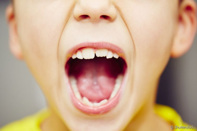 Mordida aberta: descubra o que a condição causa na saúde bucal