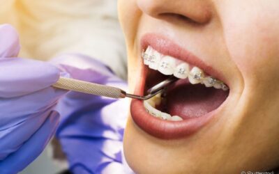 Extração de dente antes do aparelho ortodôntico: por que fazer?