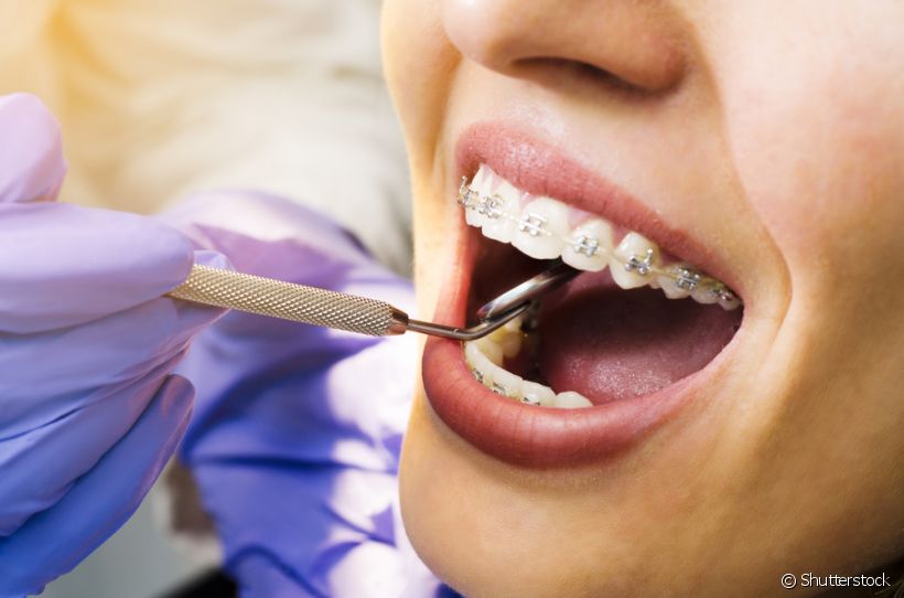 Extração de dente antes do aparelho ortodôntico: por que fazer?