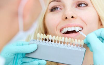 Lentes de contato dental: melhorias que vão além da estética