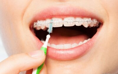 Escova interdental: para quem ela é indicada e como usar?