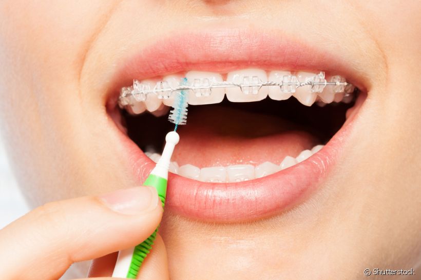 Escova interdental: para quem ela é indicada e como usar?