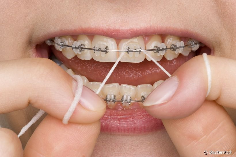 Usa aparelho ortodôntico? Veja dicas para passar o fio dental