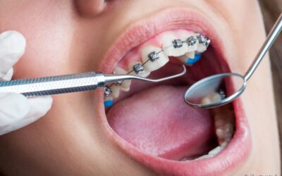 Extração do dente siso para pacientes que já estão em tratamento ortodôntico. Veja como é feito!