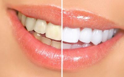 Veja como fazer clareamento dental de forma segura