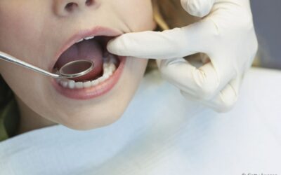 Criança pode fazer clareamento dental? Com que idade o procedimento estético é recomendado?