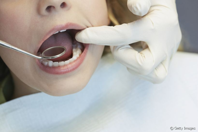 Criança pode fazer clareamento dental? Com que idade o procedimento estético é recomendado?