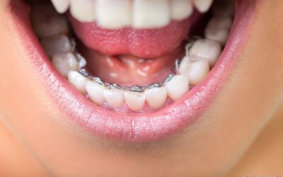 Aparelho lingual favorece o surgimento de cáries? Dentista conta