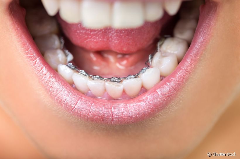Aparelho lingual favorece o surgimento de cáries? Dentista conta