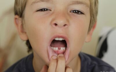 Bolha na gengiva da criança: o que pode ser? Tem a ver com o nascimento da dentição permanente? Odontopediatra explica
