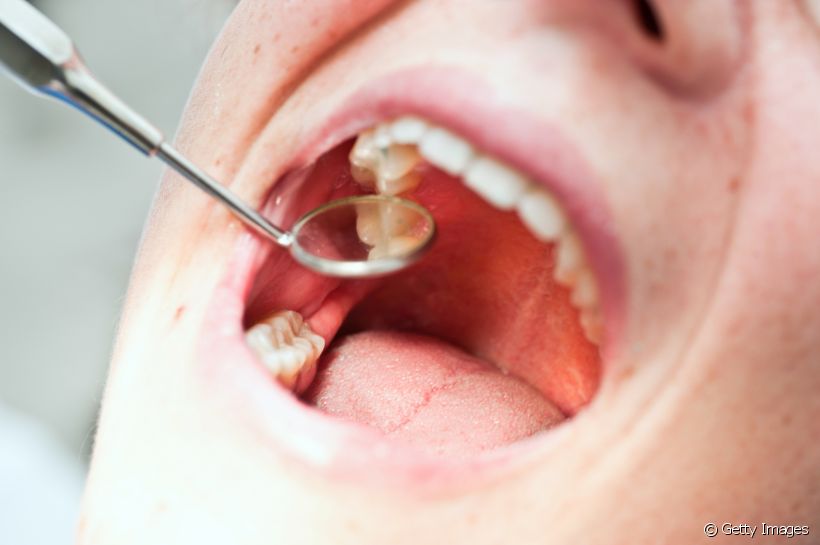 Buraco no dente pode ser cárie? Entenda os motivos dessa abertura e os riscos para a saúde bucal