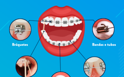 Aparelho ortodôntico fixo: conheça as estruturas do aparelho