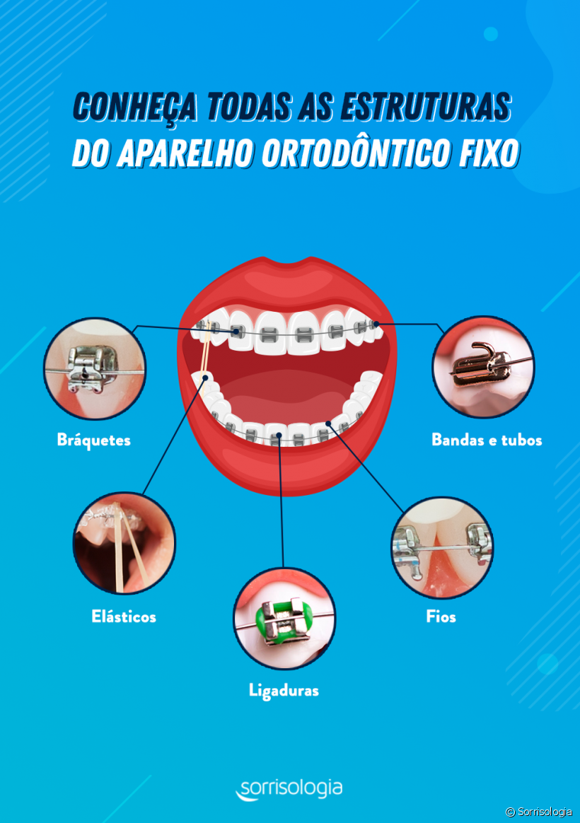 Aparelho ortodôntico fixo: conheça as estruturas do aparelho