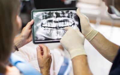 Como tirar um abscesso no dente? Dentista explica o passo a passo desse procedimento odontológico