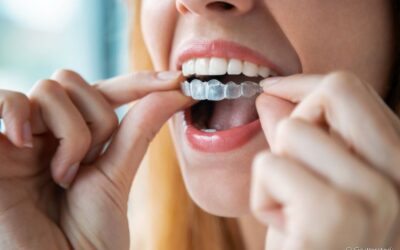 Aparelho transparente pode causar dor de dente? Ortodontista revela se esse incômodo é comum no início do tratamento ortodôntico