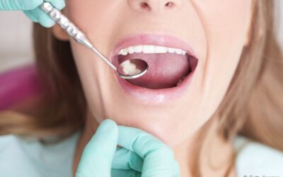 Desgaste na restauração dentária: por que isso acontece? Como prevenir e fazer com que o procedimento dure por mais tempo