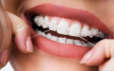 O que usar para limpar os dentes com aparelho ortodôntico?