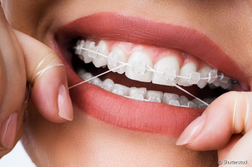 O que usar para limpar os dentes com aparelho ortodôntico?