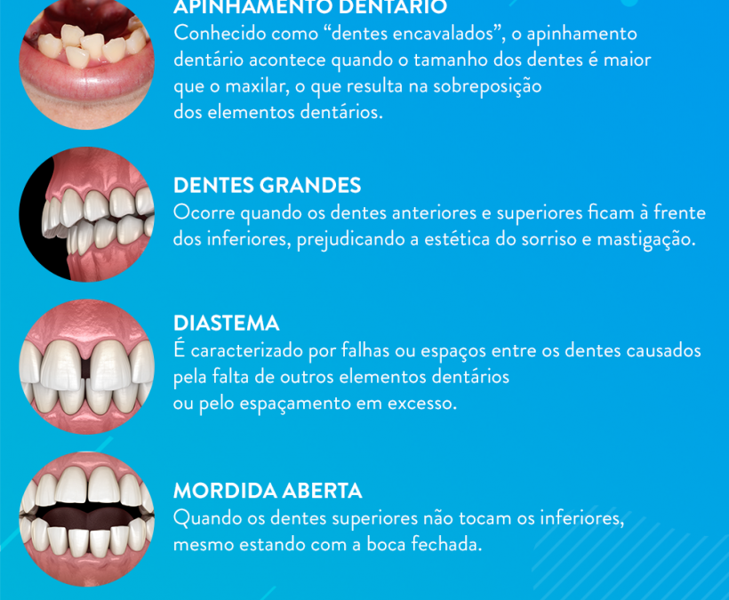 5 motivos para usar aparelho: conheça os principais problemas ortodônticos e como tratá-los (infográfico)