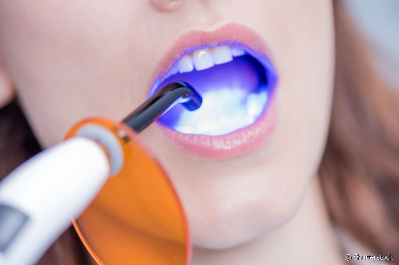 Fotopolimerizador: quais as vantagens de usá-lo no tratamento dental?