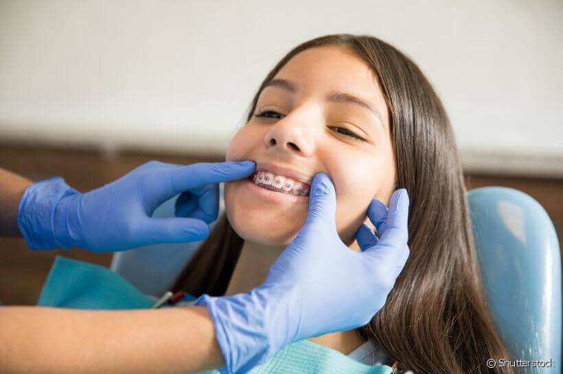 Para que servem os parafusos de ancoragem na ortodontia?