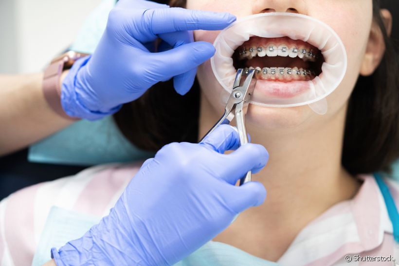 Manutenção do aparelho dental fixo: saiba tudo sobre essa etapa do tratamento ortodôntico