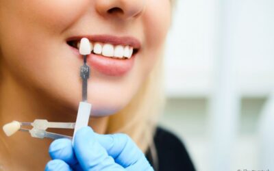 Lente de contato dental: é preciso desgastar os dentes?