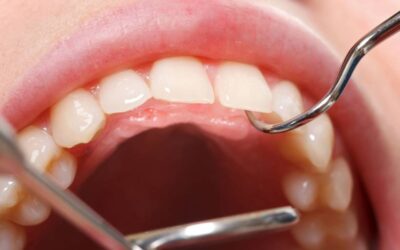 Entenda as causas e riscos dos dentes inclusos para a saúde bucal