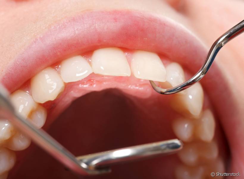 Entenda as causas e riscos dos dentes inclusos para a saúde bucal