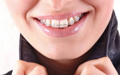 5 situações que só quem usa aparelho dentário vai entender