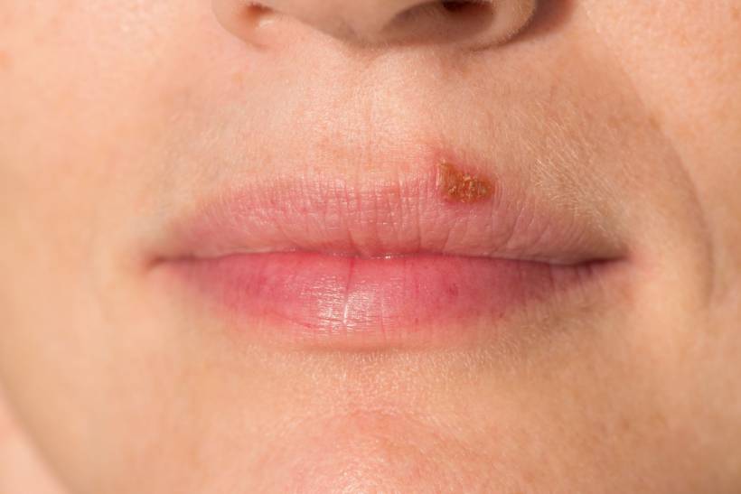 Herpes na boca: 5 mitos e verdades sobre o vírus