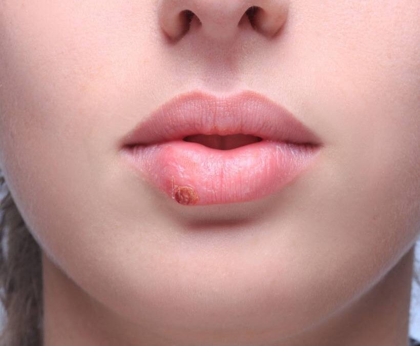 Herpes na boca: cuidados simples para evitar as lesões
