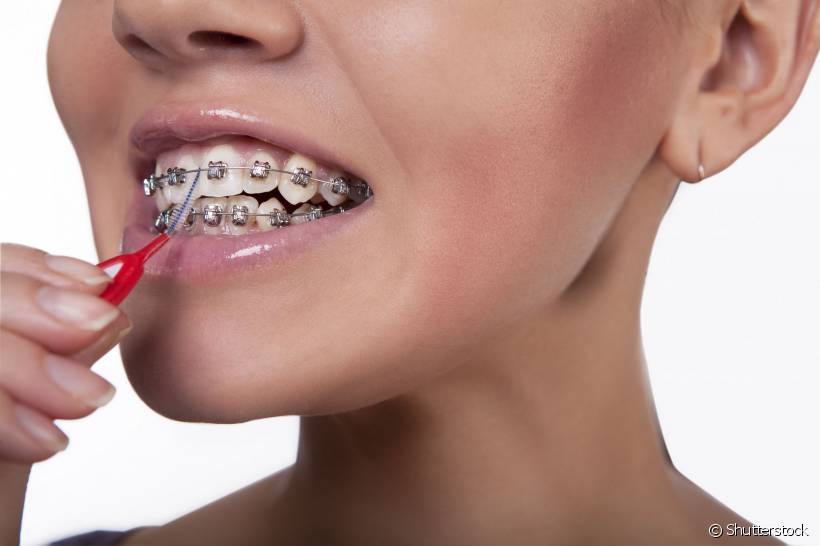 Aparelho fixo: dentes podem ficar manchados ao fim do tratamento?