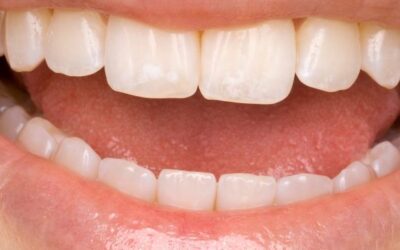 Antes e depois: como a restauração pode salvar um dente quebrado