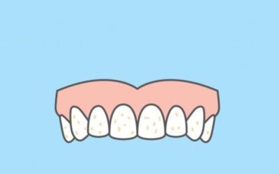 Antes e depois da fluorose dentária: conheça as opções
