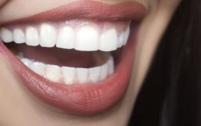 Facetas dentárias: uma alternativa para o seu sorriso! Confira o antes e depois do tratamento