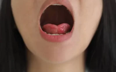 Dor no freio da língua: o que pode ser?