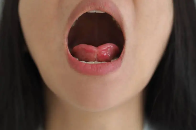 Dor no freio da língua: o que pode ser?