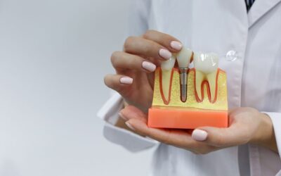 Você sabe tudo sobre implante dental e prótese?