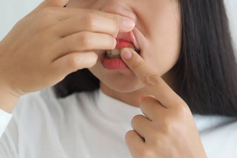 Machucado na gengiva perto do dente: pode ser algo grave?