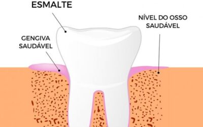 Riscos e sintomas da Periodontite: o que você precisa saber