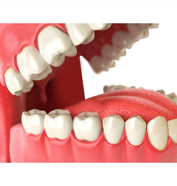 Saiba mais sobre implante dentário e compare o antes e depois